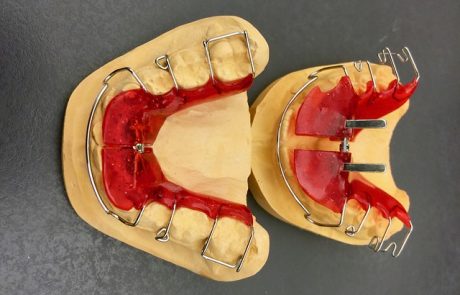 כמה זמן מחזיקים שתלים בשיניים?